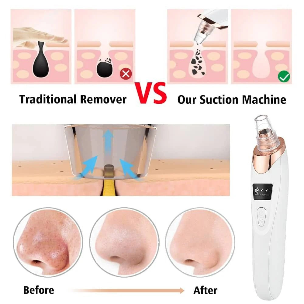 Electric Blackhead Remover – Deep Pore Facial Cleaner